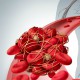 Thrombosis | Learn about the prevention and treatment of thrombosis